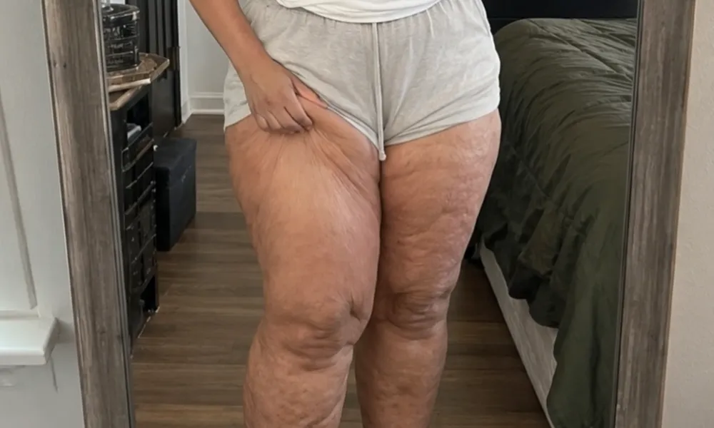 3 Signs Your Leg Swelling Isn't Just Weight (Doctors Rarely Mention This)