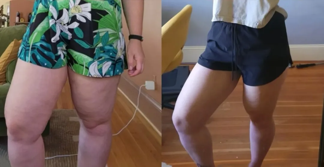 Wear Shorts Again: This 2-Second Ritual Melts Away Heavy, Painful Legs
